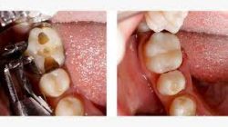 Fix Cavity on Front Tooth | Composite Front Tooth Cavity Filling or Bonding