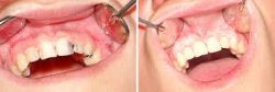 Fix Cavity on Front Tooth | Composite Front Tooth Cavity Filling or Bonding