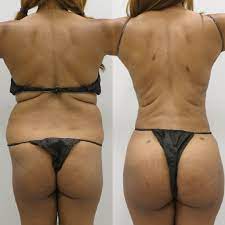Body Liposuction Houston Tx | Cosmetic Surgery Center Near me | Premiere Surgical Arts