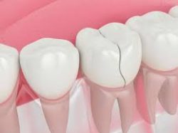 Dental Crown vs Filling | Tooth Restoration Procedures