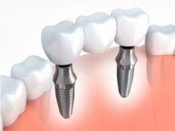 How much does a dental implant cost?