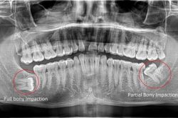 Managing the Cost of Wisdom Teeth Removal Houston