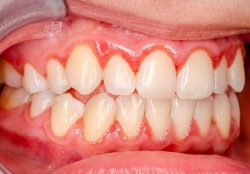 Dental Emergencies Near Me | Impacted Wisdom Teeth
