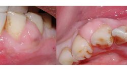 What Are Symptoms Of Abscess Tooth | Signs Of Abscess Tooth