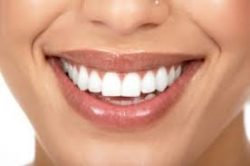 Dental Veneers Near Me | Dental Veneers Cost – Edge Dental Houston