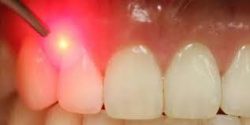 LANAP Procedure Near Me | LANAP Dentist Near Me