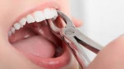 Wisdom Tooth Extraction Near Me | Surgical Tooth Extraction Cost