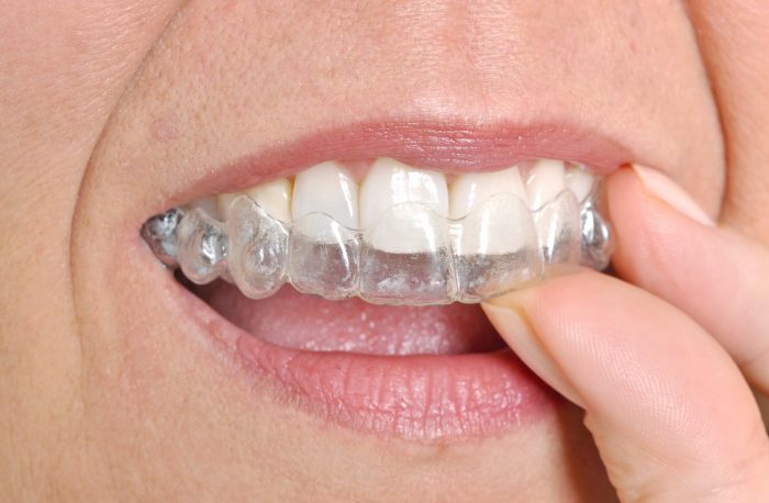 Invisalign vs Braces Cost | Gingivectom