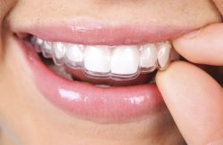 How Much Does Invisalign Cost In Texas? | Dental Bonding