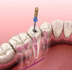 Root Canal Procedure Step-By-Step | Smile Makeover