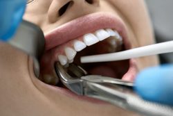 Affordable Oral Surgery: Wisdom Teeth Removal Houston – Edge Dental