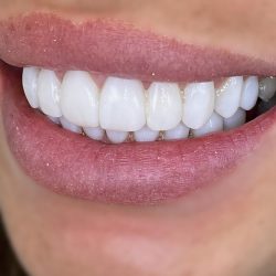 Cosmetic Dental Bonding Near Me | Porcelain Veneers