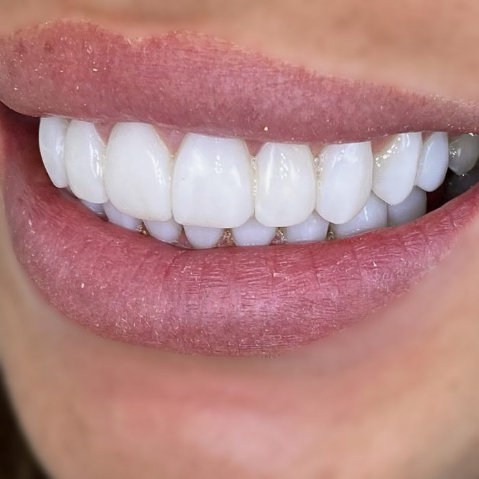 Dental Bonding Before and After | Gum Disease