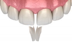 Invisalign Dentists Near Me | Gum Disease