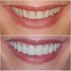 Composite Teeth Bonding Near Me | Gingivectom