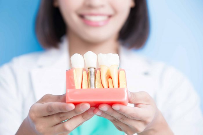 Affordable Dental Implants in Houston