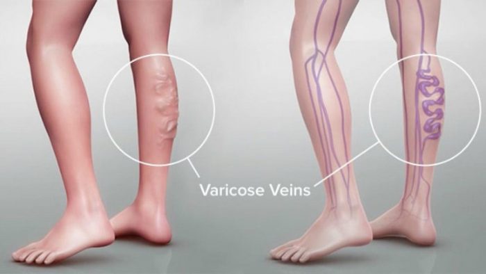 What kind of doctor treats varicose veins? Our vein doctors in Long Island answer your questions