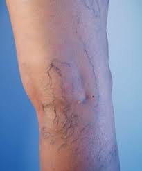 What Type of Doctor Treats Varicose Veins? | Varicose Veins in NYC