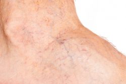 What are the Treatment Options for Varicose Veins? | Vein Treatments NYC.