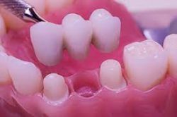 Dental Bridge Near Me | Dental Bridge Cost | Edge Dental Houston, Texas