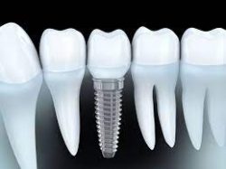 Affordable Dental Implants in Houston