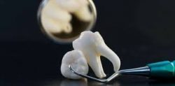 Wisdom Tooth Extraction in Sunny Isles