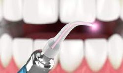 Laser Dentistry In Houston TX