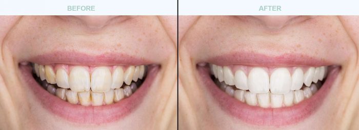 Teeth Cleaning Before And After