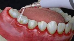 What is Gingivitis Treatment | Signs of Gingivitis Symptoms