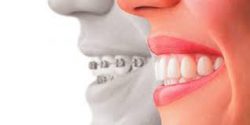 Important Facts About Invisalign Attachments | Cost Of Invisalign Treatment