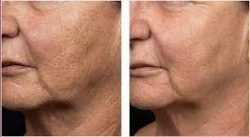 Laser Rejuvenation Houston, Texas | Skin Resurfacing | Fraxel