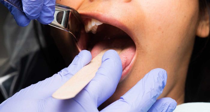 Oral Cancer Screening | Oral Cancer Symptoms & Signs