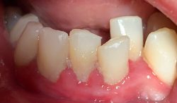 What Is Deep Cleaning Teeth