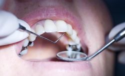 What is a Temporary Tooth Filling?