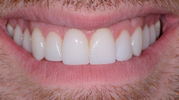 Dental Veneers Houston | Best Veneers Dentist Near Me