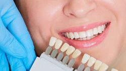 Porcelain Veneers For Gap Teeth | Cosmetic Veneers For Gap Teeth