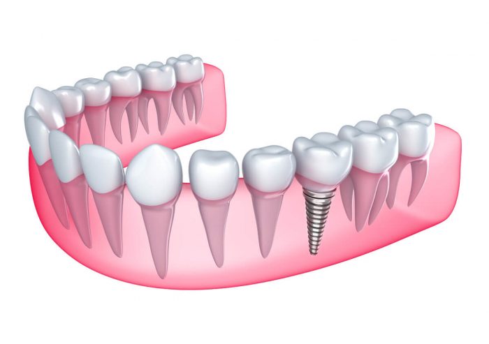 Dental Implants Office in Golden Beach