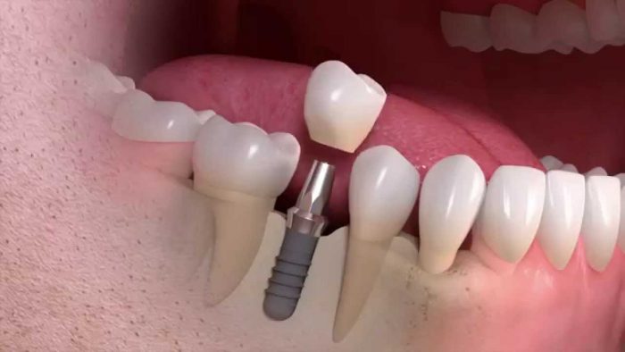 Affordable Dental Implants Near Me