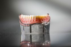 Advantages of Same-Day Dental Implants