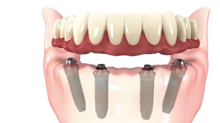 What Are Dental Implants for Dentures?