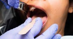 What are Dental Crowns and How Do They Work?