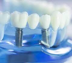 How to Find a Dental Implant Specialist – Dentist Houston TX