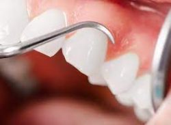 Affordable Dental Implant Near Me