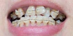 Porcelain Veneers For Gap Teeth | Cosmetic Veneers For Gap Teeth