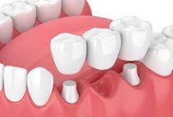 Tooth Extraction Near Me | Dental Bone Grafting After Tooth Extraction