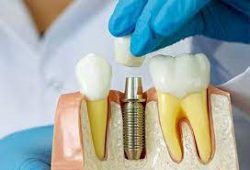 How To Fix a Cracked Tooth | Cracked Tooth Syndrome | Broken Tooth