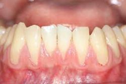 Gum Regeneration Treatment | Gum Recession Treatment Surgery