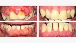 Periodontal Gum Disease Treatment | Signs of Gingivitis And Periodontitis
