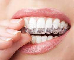 Affordable Dental Implants in Houston