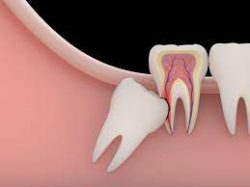 Warning Signs of Impacted Wisdom Teeth | Wisdom Teeth Removal
